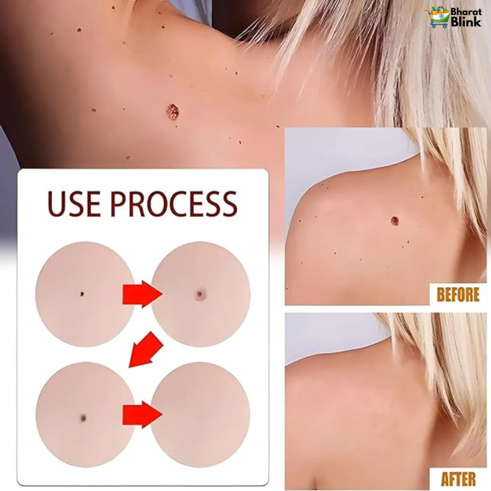 Tags & Moles Remover (Buy 1 Get 1 Free)