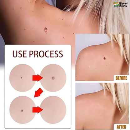 Tags & Moles Remover (Buy 1 Get 1 Free)